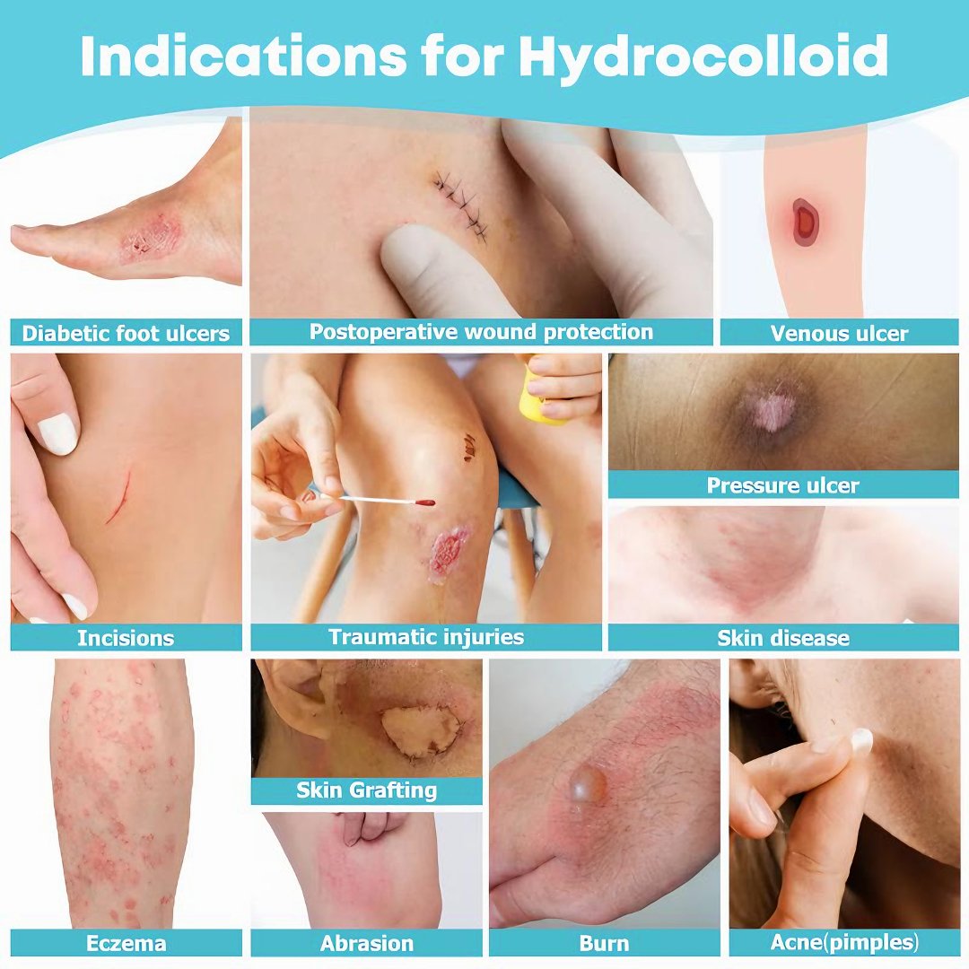 Hydrocolloid Patch Roll (Cut-to-Size Wound Care)
